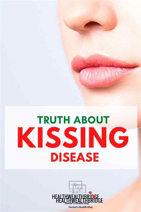 Kissing disease: The kiss of the virus (Infectious Mononucleosis ...