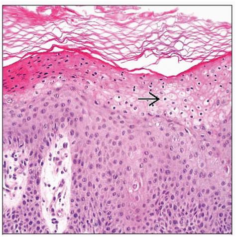 Necrolytic Migratory Erythema | Basicmedical Key