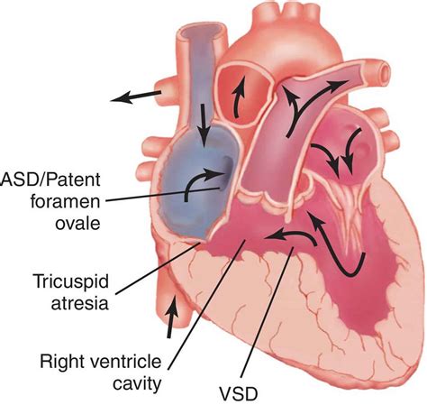 Tricuspid atresia causes, symptoms, diagnosis, treatment & prognosis