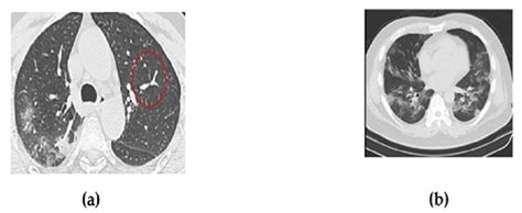 Sample CT scan images of 2 COVID-19 patients (a) COVID-19 infected (b)... | Download Scientific ...