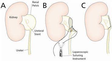 Right Laparoscopic Pyeloplasty