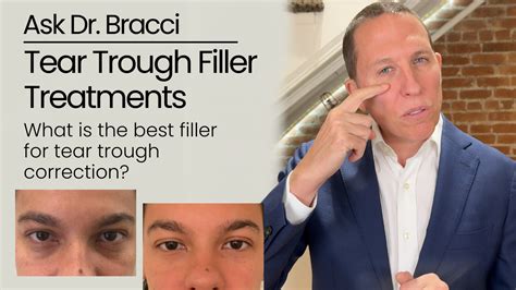 Tear Trough Filler Treatments: What Is The Best Filler?