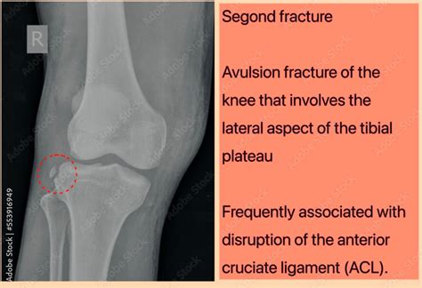 Segond fracture knee X-ray., Segond fracture is an avulsion fracture of the knee that involves ...