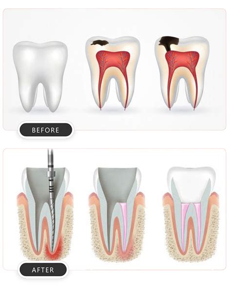 Tooth Nerve Removal