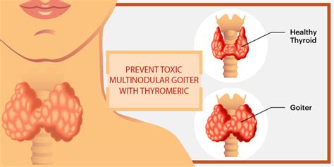 Study proves Curcumin can Help in Toxic Multinodular Goiter