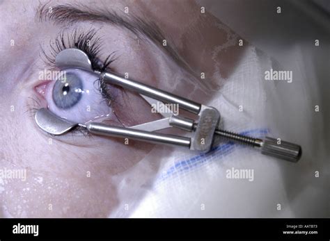 A PATIENTS EYE IS CLAMPED PRIOR TO LASER EYE SURGERY MANDATORY CREDIT MICHAEL CRAIG http www ...