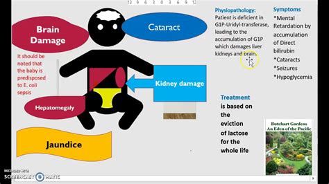 What is Galactosemia? Cause Diagnosis Treatment Classic vs Galactokinase Deficiency Jaundice ...