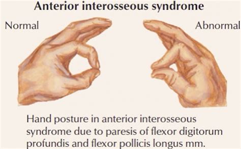 Pediatric Supracondylar Fractures – Core EM