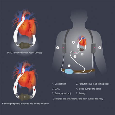 Left Ventricular Assist Devices (LVAD): Surgery and Treatment | NewYork ...