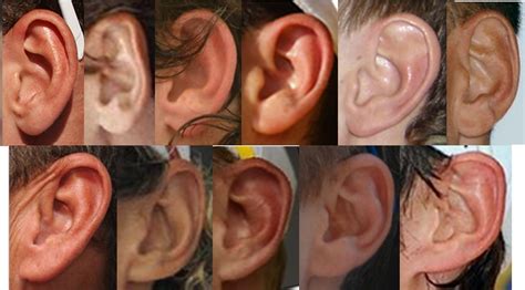 Myths of Human Genetics: Earlobes