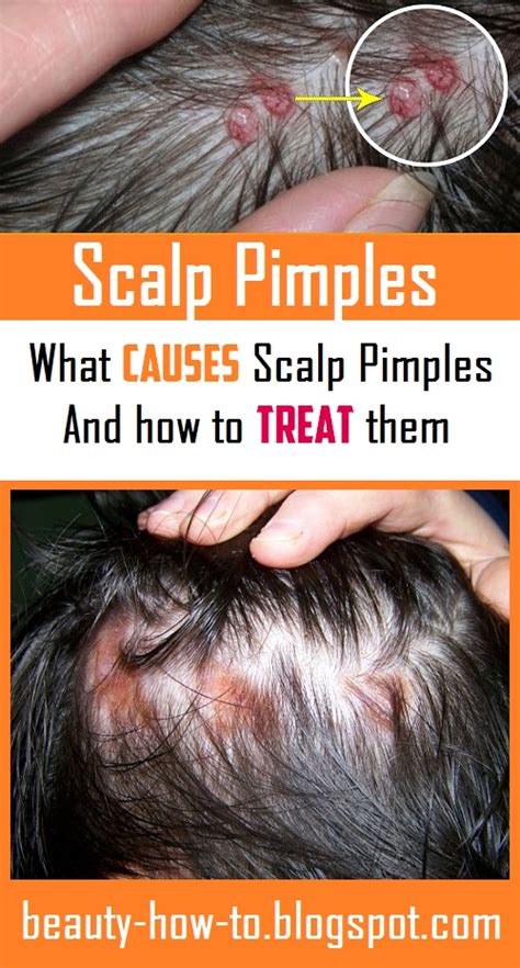 Scalp Pimples: What Causes them and how to Treat them - How To Beauty