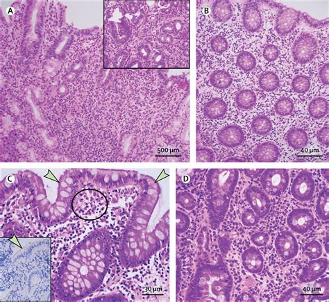 Eosinophilic gastroenteritis and other eosinophilic gut diseases distal to the oesophagus - The ...