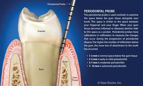 Understanding Periodontal Pockets