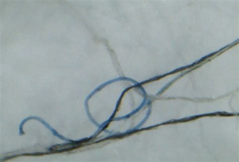 Morgellons Disease - Pictures, Symptoms, Causes, Treatment