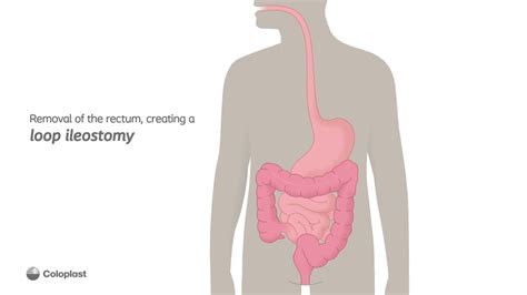 Creation of loop ileostomy by removing the rectum | Ostomy surgery | Coloplast India - YouTube