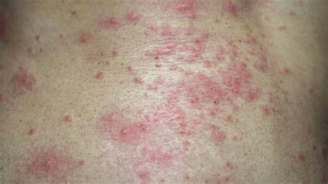 Skin Rashes Causes Symptoms Treatment - vrogue.co