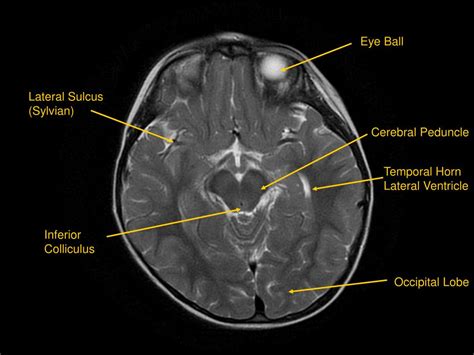 PPT - MRI of Brain/Head and Neck PowerPoint Presentation, free download - ID:601876