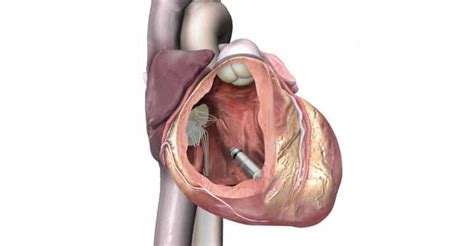 Medtronic Takes Leadless Pacemakers to a New Level - Omnica Corporation