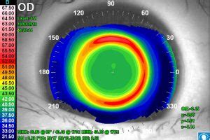 orthokeratology | Hong Kong Optometric Services Limited