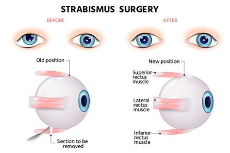 Squint Surgery: Cost, Risks, Surgeons and Benefits