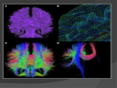 MRI Tractography IMAGING