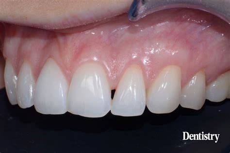 Composite restorations: closing and open gingival embrasure - Dentistry