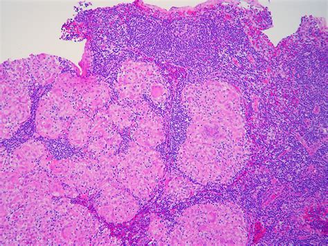 Sarcoidosis - Lymph node - non-necrotizing granulomas | Flickr - Photo Sharing!