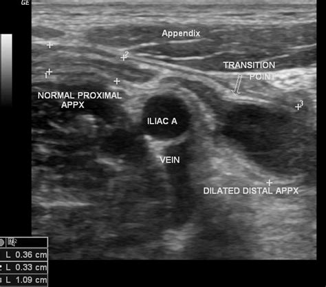 Acute appendicitis | Image | Radiopaedia.org