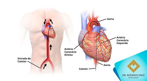 O que é o Cateterismo Cardíaco? | Dr. Rodrigo Paez - Cardiovascular