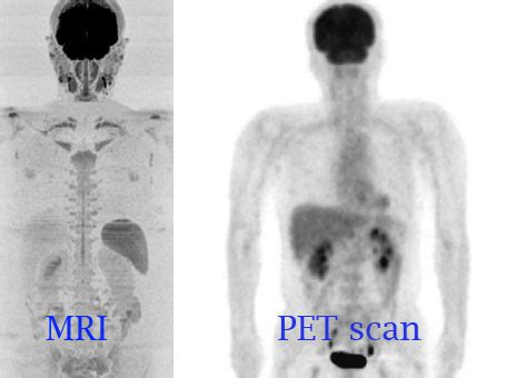 What is the difference between a PET scan and MRI? - Private MRI Scans ...