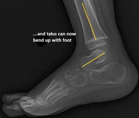 Rocker Bottom Feet Xray