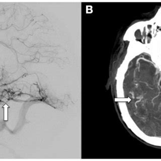 Catheter-based, diagnostic cerebral angiogram (A) and CT-angiogram (B)... | Download Scientific ...