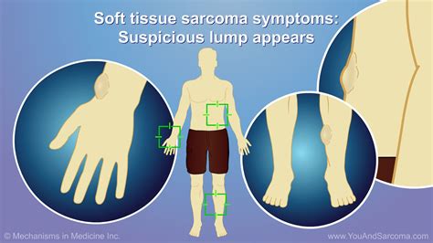 Soft tissue sarcoma usually appears as a painless lump under the skin, often on an arm or a leg ...