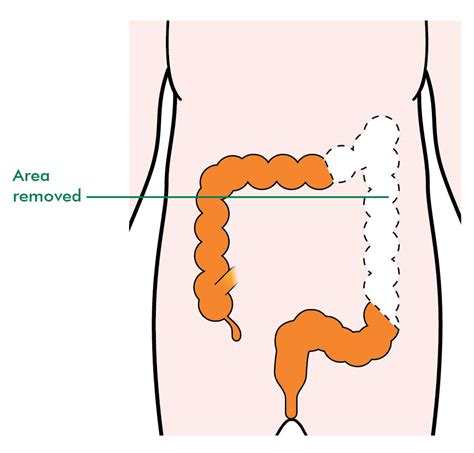 How Long Is Colon Cancer Surgery - CancerWalls