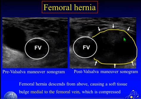 Femoral Vs Inguinal Hernia Ultrasound | Images and Photos finder