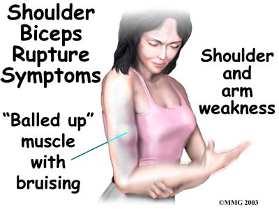 Biceps Brachii Tendon Rupture | 🩺Singapore Sports & Orthopaedic Surgeon