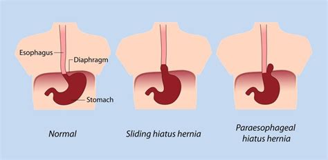 Cincinnati Ohio Hiatal Hernia Relief | Symptoms | Hiatus