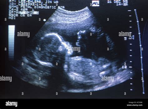 Outline of five month old fetus during ultrasound test Stock Photo ...