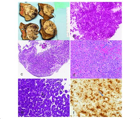 a) Gross picture of a hepatoblastoma extensively invading the liver and... | Download Scientific ...