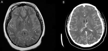 MRI, CT findings in ALL with leptomeningeal disease