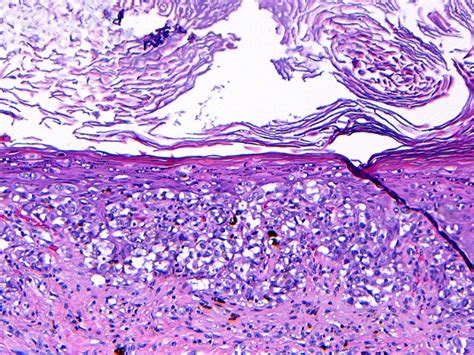 Paget's Disease Histology