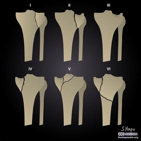 Tibial plateau fracture classification - wikidoc