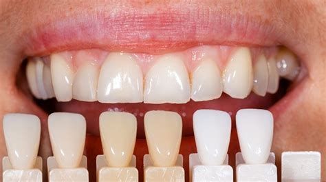 Dental Shading Problems & Solutions | Arrowhead Dental