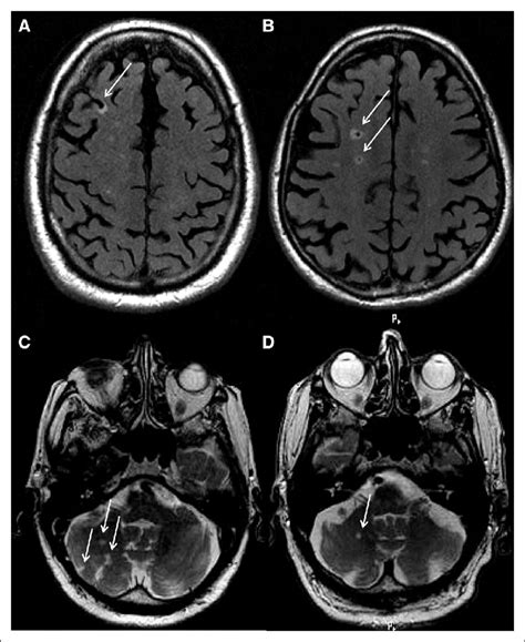 Example images of infarcts in subregions. A, Cortical infarct in the ...