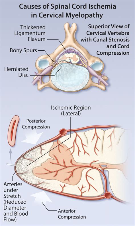 Diagnosis and Management of Cervical Myelopathy | healthPlexus.net