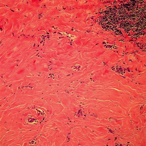 Mediastinal Tumor Discovered in 43-Year-Old Patient