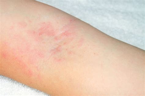 Allergy to red rash on the arms on white background Photo | Premium ...