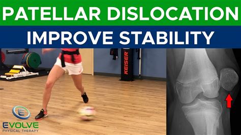 Patellar Dislocation | Improving Dynamic Knee Stability | Part 1 - YouTube