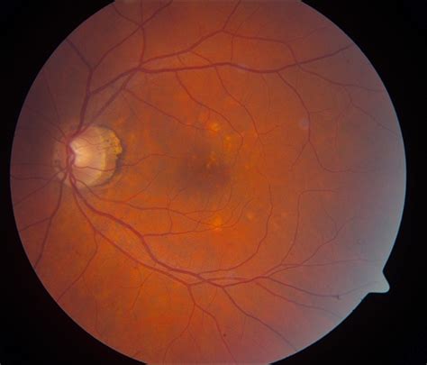 Multifocal Choroiditis - Retina Image Bank