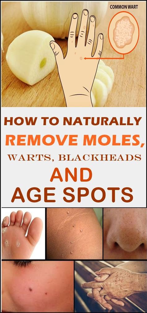 HOW TO NATURALLY REMOVE MOLES, WARTS, BLACKHEADS AND AGE SPOTS #AgeSpotsOnArms | Warts, What ...